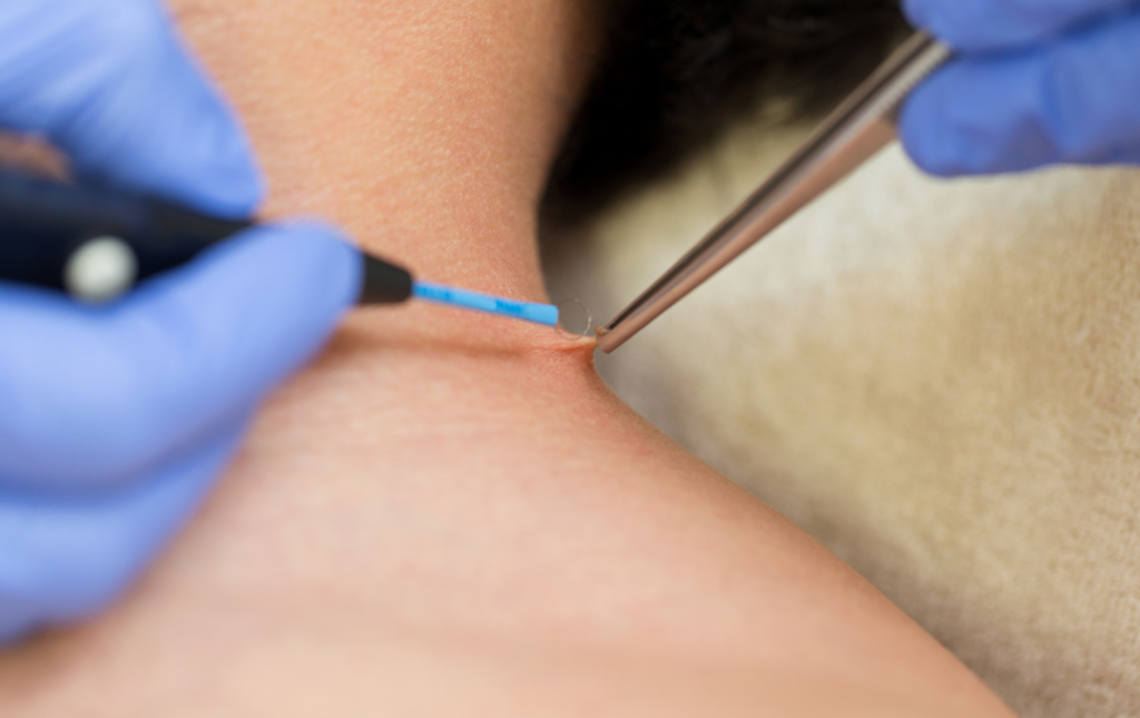 Is It Necessary To Have A Dermatologist Remove A Skin Tag