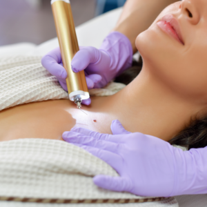 Skin Tag Removal